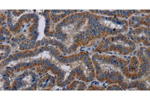 Immunohistochemistry of paraffin-embedded Human thyroid cancer tissue using KLK11 Polyclonal Antibody at dilution 1:40 (Kallikrein 11 anticorps)