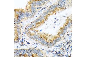 Immunohistochemistry of paraffin-embedded human colon carcinoma using COPA Rabbit mAb (ABIN7266423) at dilution of 1:100 (40x lens).