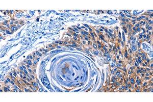 Immunohistochemistry of paraffin-embedded Human esophagus cancer tissue using CLEC2B Polyclonal Antibody at dilution 1:50 (CLEC2B anticorps)