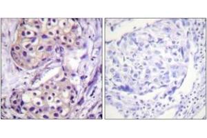 Immunohistochemistry analysis of paraffin-embedded human breast carcinoma tissue, using IKK-beta (Ab-199) Antibody. (IKBKB anticorps  (AA 166-215))