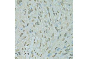 Immunohistochemistry of paraffin-embedded human liver cancer using SAFB antibody.