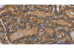 Immunohistochemistry of paraffin-embedded Human thyroid cancer using HSP40-4 Polyclonal Antibody at dilution of 1:60 (HSP40-4 anticorps)