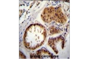 E2EPF Antibody (C-term) (ABIN388858 and ABIN2839160) immunohistochemistry analysis in formalin fixed and paraffin embedded human breast carcinoma followed by peroxidase conjugation of the secondary antibody and DAB staining.