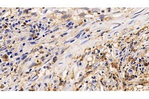 Detection of IL13Ra2 in Human Lung cancer Tissue using Polyclonal Antibody to Interleukin 13 Receptor Alpha 2 (IL13Ra2)