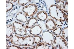 Immunohistochemical staining of paraffin-embedded Carcinoma of liver tissue using anti-LIPG mouse monoclonal antibody. (LIPG anticorps)