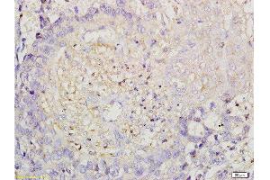 Formalin-fixed and paraffin embedded human esophageal carcinoma labeled with Anti-ROCK1 Polyclonal Antibody, Unconjugated  at 1:200 followed by conjugation to the secondary antibody and DAB staining. (ROCK1 anticorps  (AA 1001-1200))