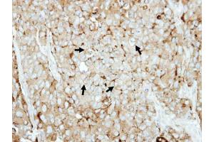 IHC-P Image Immunohistochemical analysis of paraffin-embedded BT474 xenograft, using LAMP2, antibody at 1:500 dilution.