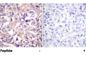 Immunohistochemical analysis of paraffin-embedded human breast carcinoma tissue using TK1 polyclonal antibody . (TK1 anticorps  (Ser13))
