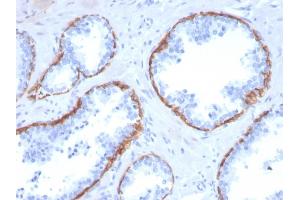 Formalin-fixed, paraffin-embedded human Prostate Carcinoma stained with Cytokeratin 5 Mouse Monoclonal Antibody (KRT5/3594).
