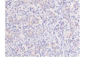 ABIN6267606 at 1/200 staining Human lung cancer tissue sections by IHC-P.