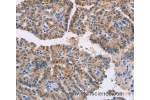 Immunohistochemistry of Human thyroid cancer using NCR1 Polyclonal Antibody at dilution of 1:20 (NCR1 anticorps)