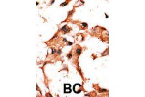 Formalin-fixed and paraffin-embedded human cancer tissue reacted with BIRC3 polyclonal antibody  , which was peroxidase-conjugated to the secondary antibody, followed by DAB staining. (BIRC3 anticorps  (N-Term))