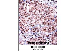 TERF2IP Antibody immunohistochemistry analysis in formalin fixed and paraffin embedded human breast carcinoma followed by peroxidase conjugation of the secondary antibody and DAB staining. (RAP1 anticorps  (C-Term))
