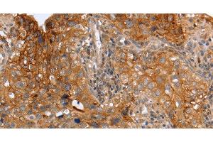 Immunohistochemistry of paraffin-embedded Human cervical cancer using PLAUR Polyclonal Antibody at dilution of 1:60 (PLAUR anticorps)