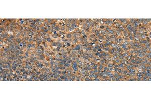 Immunohistochemistry of paraffin-embedded Human cervical cancer tissue using MYL12B Polyclonal Antibody at dilution of 1:25(x200)