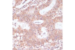 Immunohistochemistry of paraffin-embedded human colon carcinoma using BYSL antibody (ABIN6129546, ABIN6137672, ABIN6137674 and ABIN6215553) at dilution of 1:100 (40x lens). (Bystin-Like anticorps  (AA 120-280))