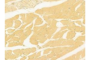 ABIN6262561 and ABIN6278898 at 1/100 staining human tongue carcinoma by IHC-P. (IL28B anticorps  (Internal Region))