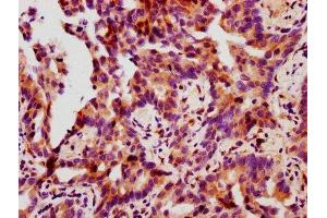 IHC image of ABIN7127700 diluted at 1:100 and staining in paraffin-embedded human lung cancer performed on a Leica BondTM system. (Recombinant HSP27 anticorps  (pSer78))