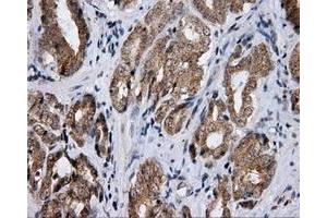 Immunohistochemical staining of paraffin-embedded Adenocarcinoma of ovary tissue using anti-LIPG mouse monoclonal antibody. (LIPG anticorps)