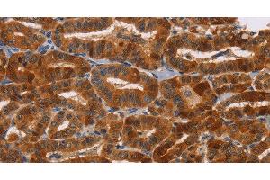 Immunohistochemistry of paraffin-embedded Human thyroid cancer tissue using NCR1 Polyclonal Antibody at dilution 1:30 (NCR1 anticorps)