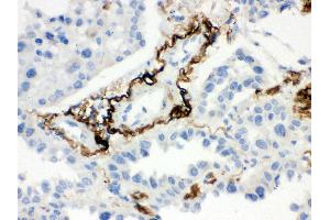Anti- Vitronectin Picoband antibody, IHC(P) IHC(P): Human Lung Cancer Tissue (Vitronectin anticorps  (C-Term))