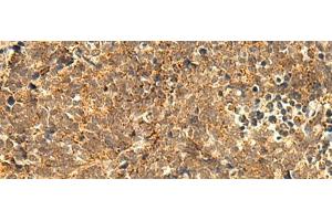 Immunohistochemistry of paraffin-embedded Human lung cancer tissue using ABHD10 Polyclonal Antibody at dilution of 1:50(x200) (ABHD10 anticorps)