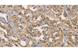 Immunohistochemistry of paraffin-embedded Human thyroid cancer tissue using DACH2 Polyclonal Antibody at dilution 1:40 (DACH2 anticorps)