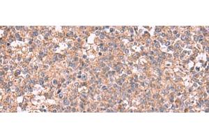 Immunohistochemistry of paraffin-embedded Human tonsil tissue using MAPK8IP3 Polyclonal Antibody at dilution of 1:45(x200)