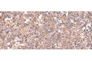Immunohistochemistry of paraffin-embedded Human tonsil tissue using MAPK8IP3 Polyclonal Antibody at dilution of 1:45(x200) (JIP3 anticorps)