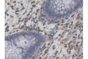 DAB staining on IHC-P; Samples: Human Colorectal cancer Tissue