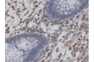 DAB staining on IHC-P; Samples: Human Colorectal cancer Tissue (NFIA anticorps  (AA 1-143))