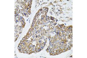 Immunohistochemistry of paraffin-embedded human esophageal cancer using MTTP antibody (ABIN5970876) at dilution of 1/100 (40x lens). (MTTP anticorps)