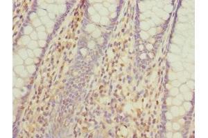 Immunohistochemistry of paraffin-embedded human colon cancer using ABIN7163880 at dilution of 1:100