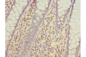Immunohistochemistry of paraffin-embedded human colon cancer using ABIN7163880 at dilution of 1:100 (GALNT2 anticorps  (AA 442-571))