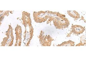 Immunohistochemistry of paraffin-embedded Human thyroid cancer tissue using CXCL6 Polyclonal Antibody at dilution of 1:45(x200) (CXCL6 anticorps)