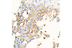 Immunohistochemistry of paraffin-embedded Human urothelial carcinoma using CE antibody (ABIN7266084) at dilution of 100 (40x lens).