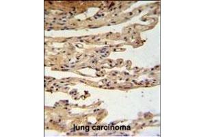 FKBPL Antibody (C-term) (ABIN1881347 and ABIN2840192) IHC analysis in formalin fixed and paraffin embedded lung carcinoma followed by peroxidase conjugation of the secondary antibody and DAB staining. (FKBPL anticorps  (C-Term))