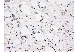 Immunohistochemical staining of paraffin-embedded Carcinoma of kidney tissue using anti-PLK1mouse monoclonal antibody. (PLK1 anticorps)