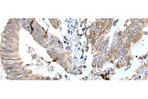 Immunohistochemistry of paraffin-embedded Human colorectal cancer tissue using GKN1 Polyclonal Antibody at dilution of 1:30(x200) (Gastrokine 1 anticorps)