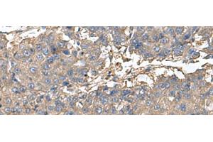Immunohistochemistry of paraffin-embedded Human liver cancer tissue using BLOC1S6 Polyclonal Antibody at dilution of 1:95(x200) (Pallidin anticorps)
