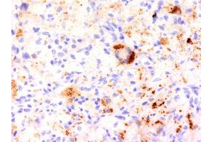 Formalin-fixed, paraffin-embedded human Erdheim-Chester disease (also known as polyostotic sclerosing histiocytosis) stained with TNF alpha Monoclonal Antibody (TNF706). (TNF alpha anticorps  (N-Term))