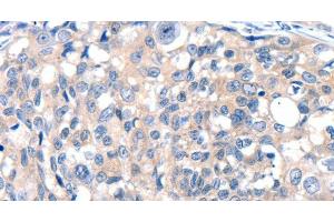 Immunohistochemistry of paraffin-embedded Human breast cancer tissue using GRIN2D Polyclonal Antibody at dilution 1:30 (GRIN2D anticorps)
