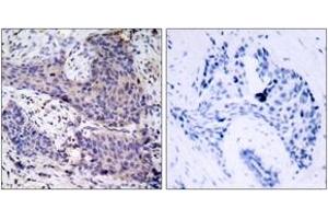 Immunohistochemistry analysis of paraffin-embedded human breast carcinoma tissue, using BAD (Ab-136) Antibody. (BAD anticorps  (AA 102-151))