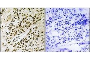 Immunohistochemistry analysis of paraffin-embedded human breast carcinoma, using MAPKAPK5 (Phospho-Thr182) Antibody. (MAPKAP Kinase 5 anticorps  (pThr182))