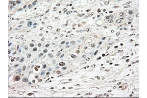 Immunohistochemical staining of paraffin-embedded Carcinoma of pancreas tissue using anti-TYRO3mouse monoclonal antibody. (TYRO3 anticorps)