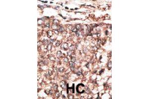 Immunohistochemical staining (Formalin-fixed paraffin-embedded sections) of human hepatocarcinoma. (PDGFD anticorps  (AA 313-341))