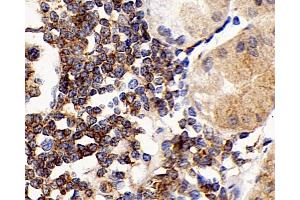 Immunohistochemistry analysis of paraffin-embedded human stomach cancer using CD192 Polyclonal Antibody at dilution of 1:300. (CCR2 anticorps)