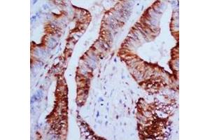 Immunohistochemical analysis of paraffin embedded Mammary cancer sections, staining MAPK1-3 in cytoplasm and nucleus, DAB chromogenic reaction