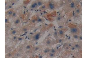 Detection of CKMT1A in Human Liver cancer Tissue using Polyclonal Antibody to Creatine Kinase, Mitochondrial 1A (CKMT1A)