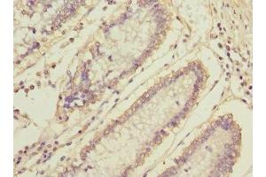 Immunohistochemistry of paraffin-embedded human colon cancer using ABIN7160476 at dilution of 1:100